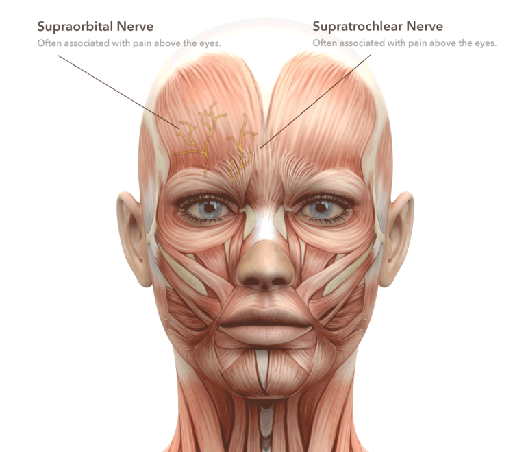 Migraine Headache Surgery Zones Located In Bangor, Maine